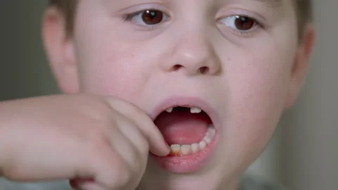 A Boy Aged 5-6 Years Experienced Loose Front Teeth. Children Dentistry Concept. Stock Footage 304105214