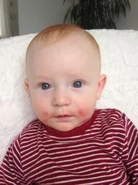 A boy with allergy Stock Photos