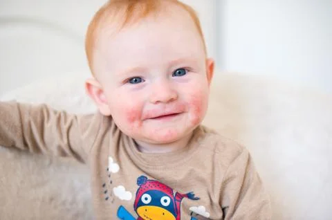Boy with atopic dermatitis Stock Photos