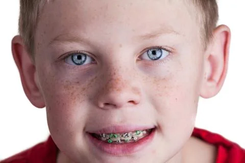 Boy with braces Foto stock