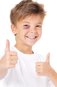 Boy with bruise Stock Photos