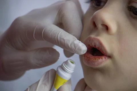 Boy with chapped lips treatment. Selective focus Stock Photos