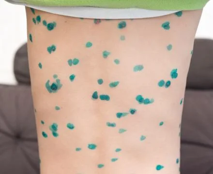 Boy with chicken pox Stock Photos