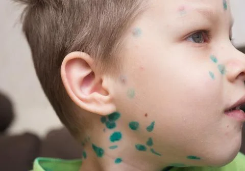 Boy with chicken pox Stock Photos