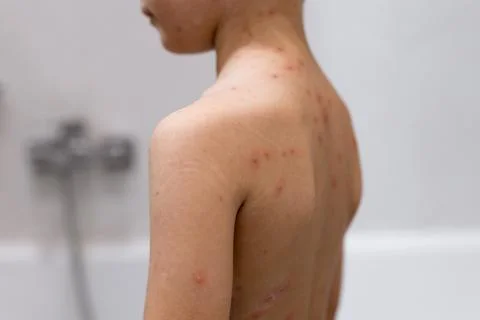 Boy with chicken pox. Rash on child body close up Stock Photos