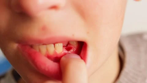 The boy is crying, experiencing a little pain after his front baby tooth was Stock Footage 264168185