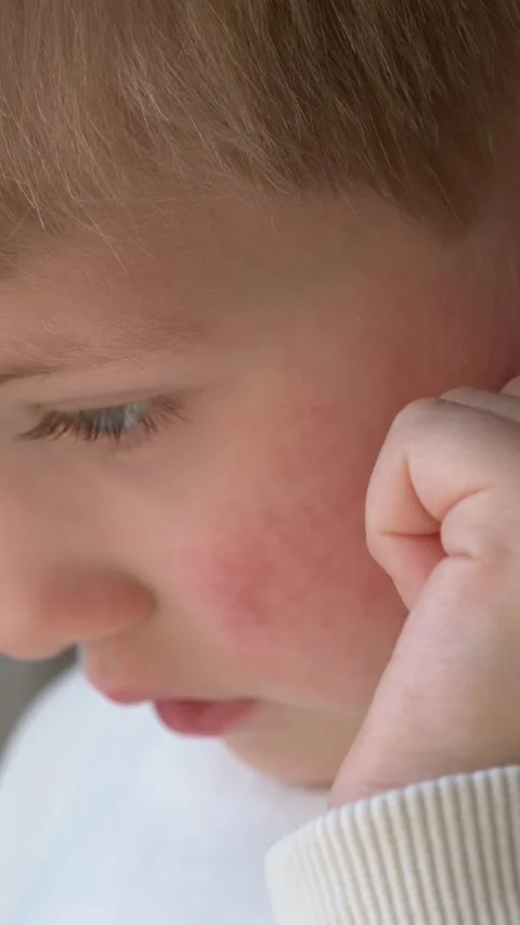 Boy face macro view shows infection related rash. Infection symptoms tied to Stock Footage 330973364