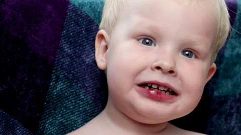 The boy has a broken wound on the lips Stock Footage 90352201
