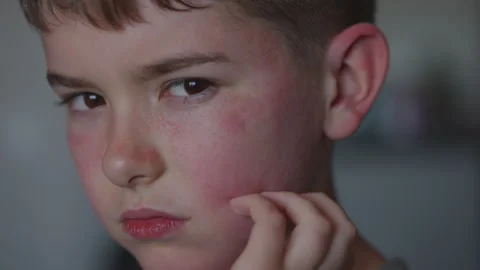 Boy Having Allergic Reaction on Skin to Food..Boy Has Dry Red Skin and Scra.. Video stock 331748366