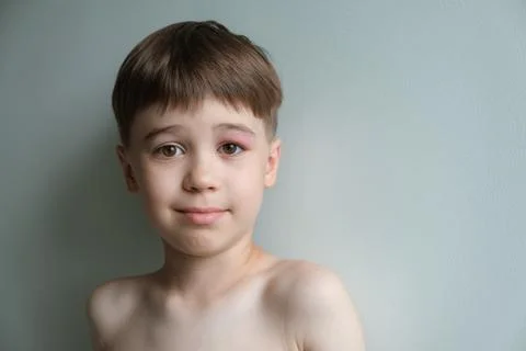 The boy looking at the camera with a swollen eye from an insect bite close-.. Stock Photos