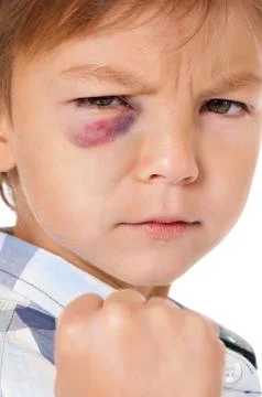 Boy with real bruise Stock Photos