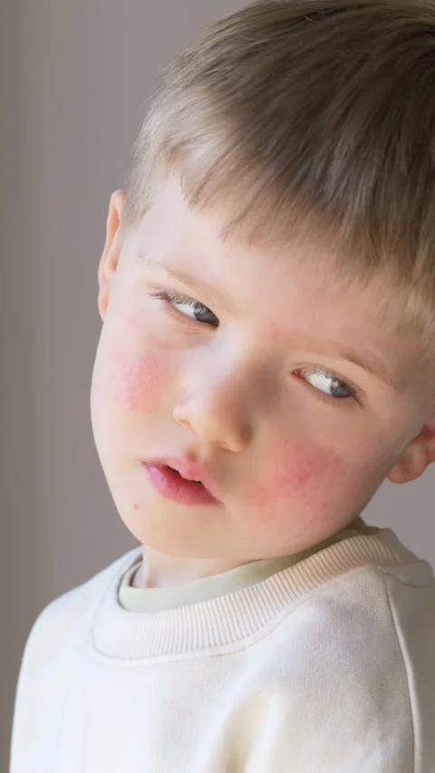 Boy with red cheeks and rash looking aside, allergy and dermatitis symptoms in Stock Footage 330973296