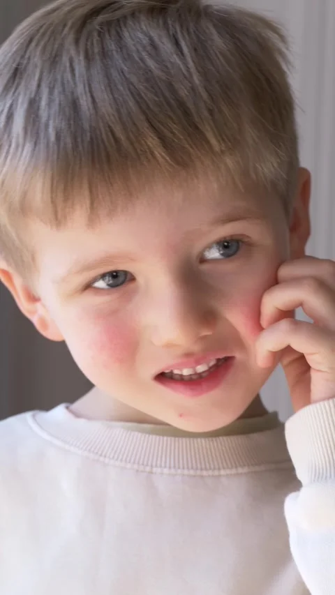 Boy scratching cheek shows skin rash and irritation clearly. Itch symptom Stock-Footage 330973383