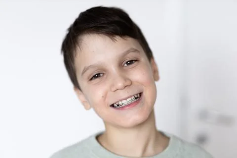 Boy smiling with tooth retainers . Concept of crooked teeth correction and bite Stock Photos