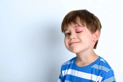 A boy with swollen eye from insect bite. Quincke edema. Portrait of child Stock Photos
