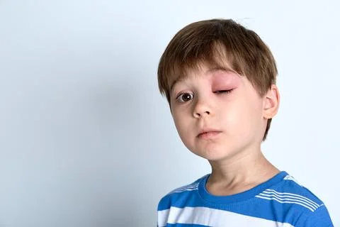 A boy with swollen eye from insect bite. Quincke edema. Portrait of child Stock Photos