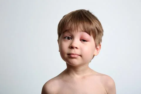 A boy with swollen eye from insect bite. Quincke edema. Portrait of Caucasian Stock Photos