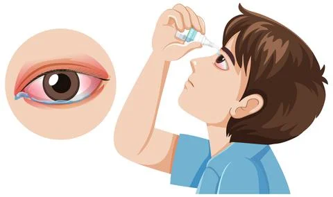 Boy Using Eye Drops for Red Irritated Eye Stock Illustration
