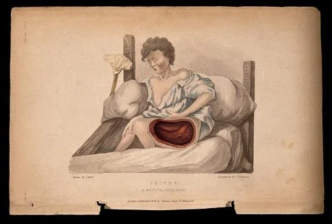 A boy with a wounded thigh seated on a bed; a crutch to his right. Coloured.. Stock Illustration