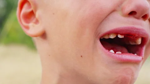 The boy's tooth was pulled out with a thread, and he is crying. Stock Footage 256210111