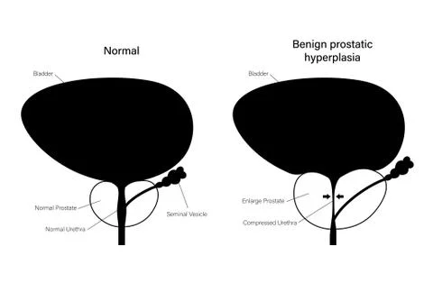 BPH info concept Illustrazione stock