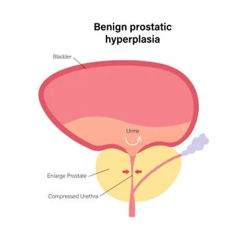 BPH info concept Stock Illustration