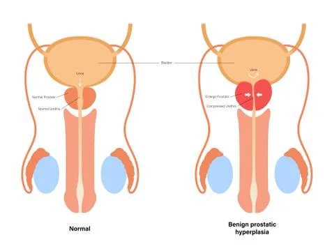 BPH info concept Stock Illustration