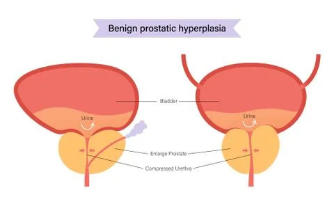 BPH info concept Stock Illustration