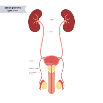 BPH info concept Stock Illustration