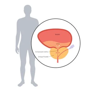 BPH info concept Stock Illustration