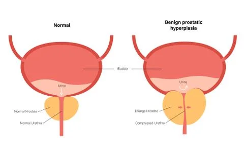 BPH info concept Stock Illustration