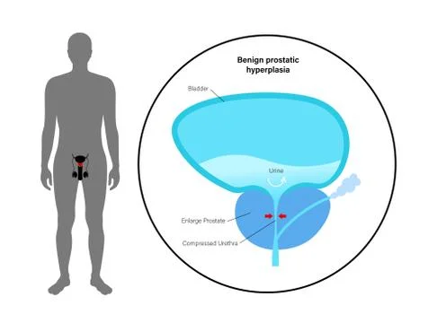 BPH info concept Stock Illustration