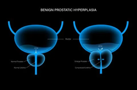 BPH info concept Stock Illustration