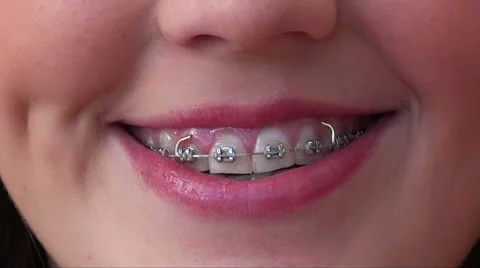  brace on teeth 16 year old girl with Stock Footage 4885289