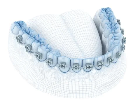 Braces and denture. Wire 3d model illustration Stock Illustration