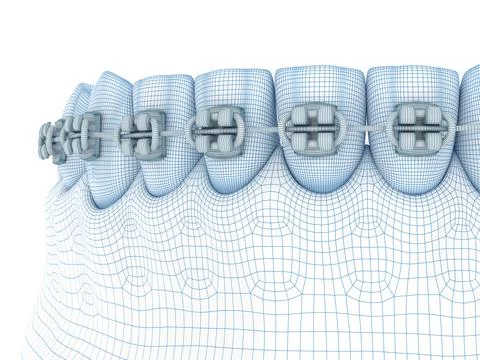 Braces and denture. Wire 3d model illustration Stock Illustration