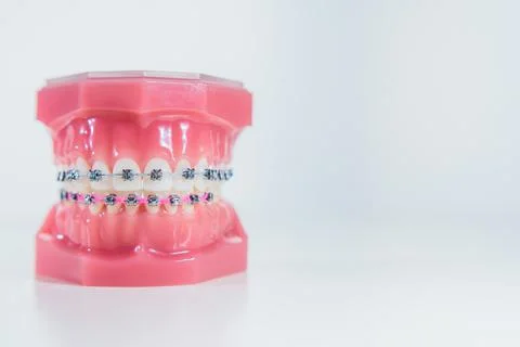 The braces are placed on the teeth in the artificial jaw on a white backgroun 스톡 사진