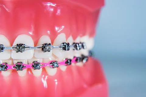 The braces are placed on the teeth in the artificial jaw. Macro photography Stock Photos