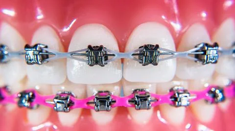 The braces are placed on the teeth in the artificial jaw. Macro photography Stock Photos