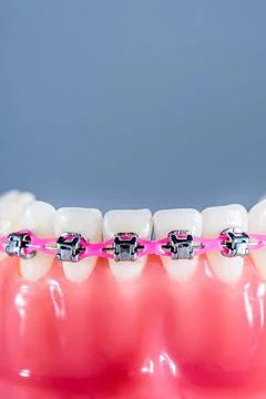 Braces are placed on the teeth in the artificial jaw against a light blue bac Stock Photos
