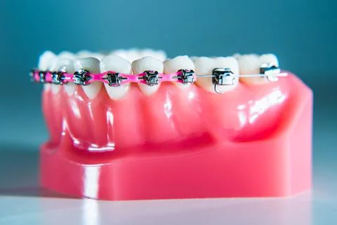 Braces are placed on the teeth in the artificial jaw against a light blue bac Stock Photos