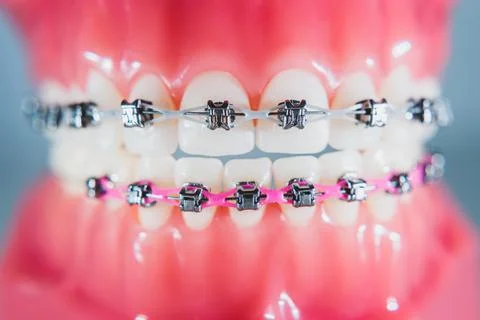 The braces are placed on the teeth in the artificial jaw. Macro photography Stock Photos