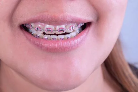 Braces close up macro Stock Photos