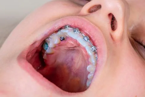 Braces for cuspid correction. Stock Photos