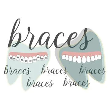 Braces dentistry in beautiful style. Vector flat design illustration. Stock Illustration