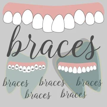 Braces dentistry in beautiful style. Vector flat design illustration. Stock Illustration