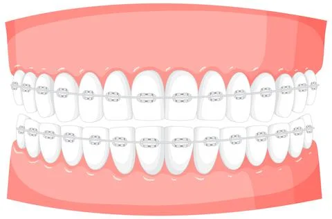 Braces on a model of human teeth Illustrazione stock
