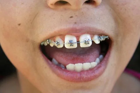 Braces Stock Photos