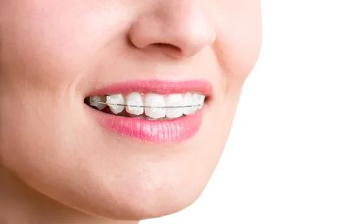 Braces Stock Photos