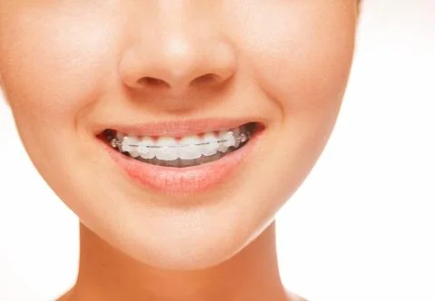Braces on teeth, close-up Stock Photos